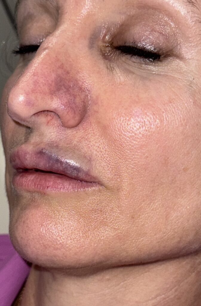 lip filler induced ischemia