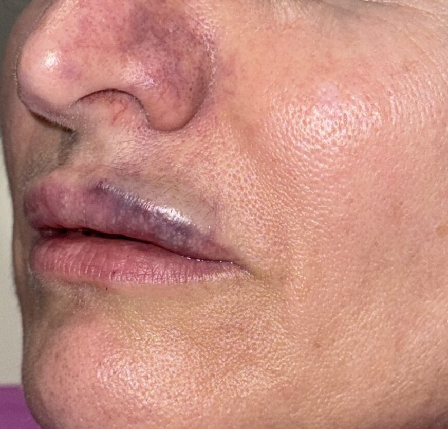 lip filler complication Screenshot