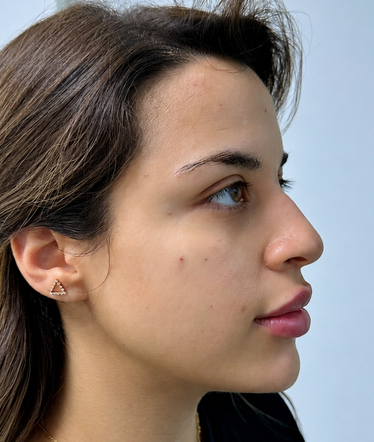 after cheek filler