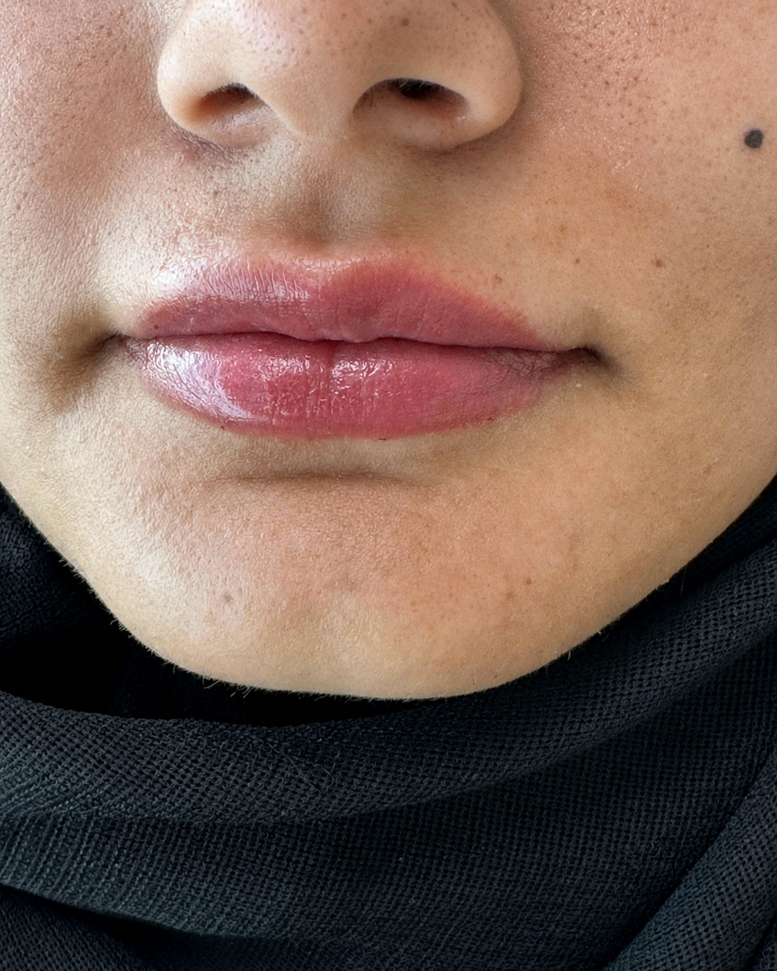 lip filler naturl maili