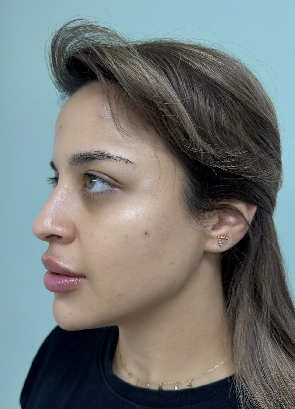 After 4cc syringes of premium filler. Indivisual results may vary