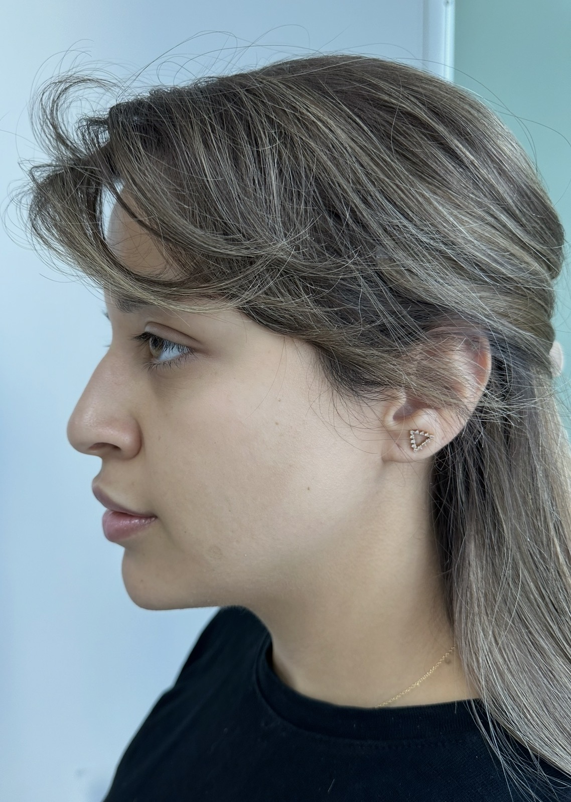 Before facial contouring with Dr.Shiva