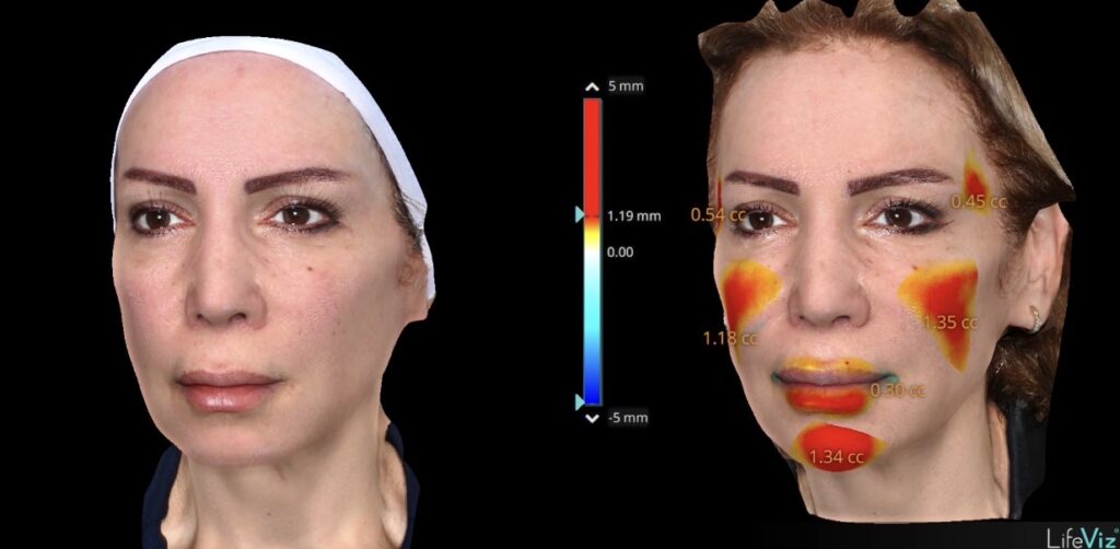 3D volume map before and after cheek, temple, chin and lip filler in Dubai / 3D imaging before and after chin and midface filler in Dubai