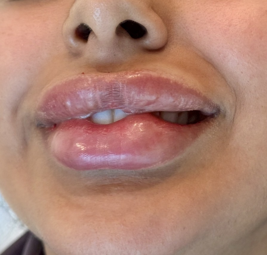 before lip dissolving