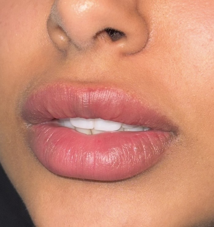 after lip dissolving with dr shiva