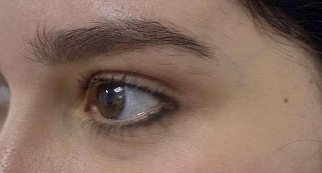 Lateral eyebrow position before and after thread lifting