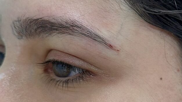 Lateral eyebrow position before and after thread lifting Lateral eyebrow position before and after thread lifting