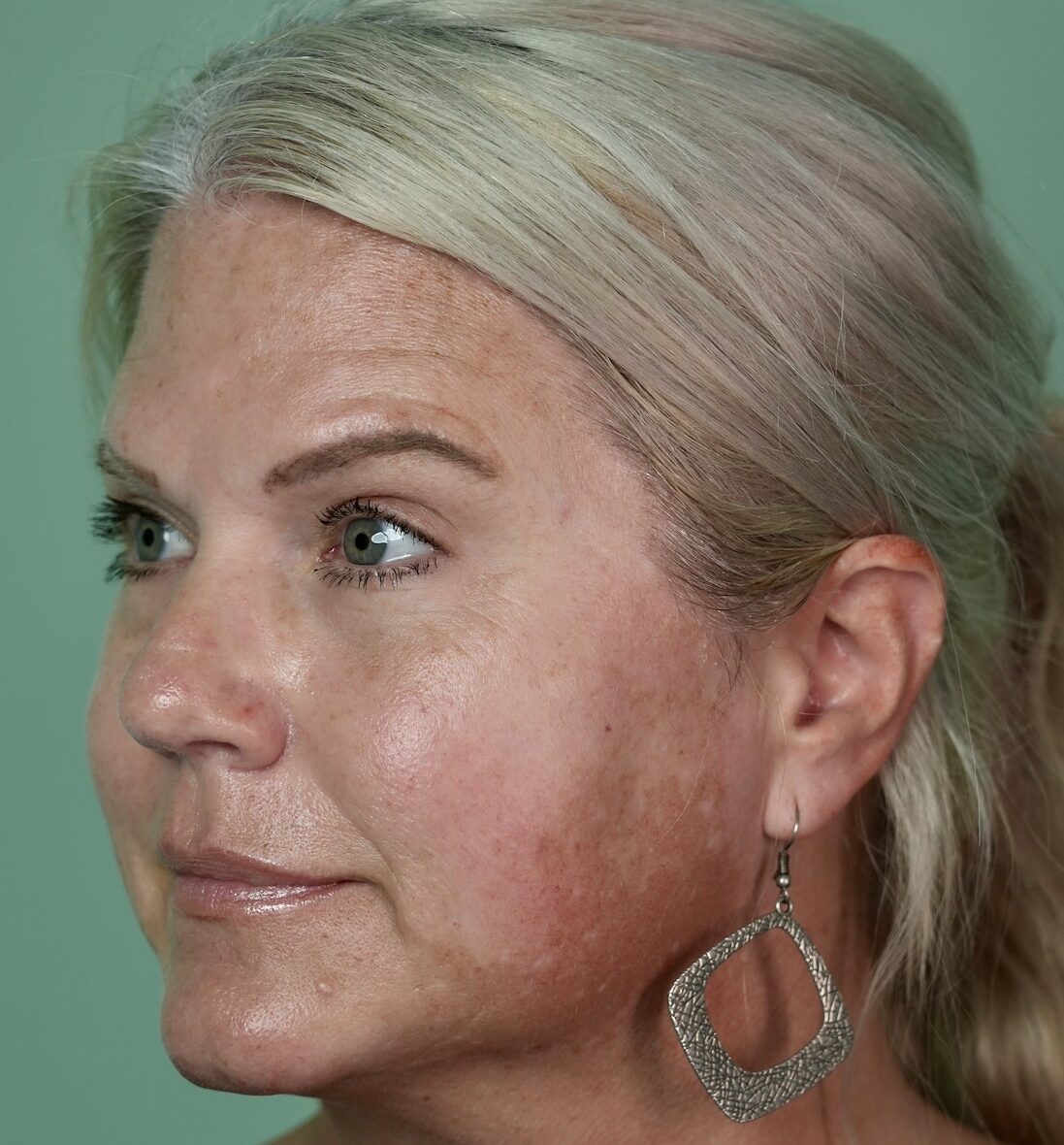 Thread lift assessment in Dubai with Dr Shiva Faramarzi Thread lift assessment in Dubai with Dr Shiva Faramarzi