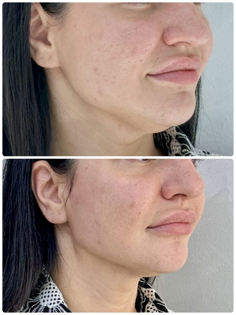 • Lower face case: Jawline and jowl thread lift result, before and after