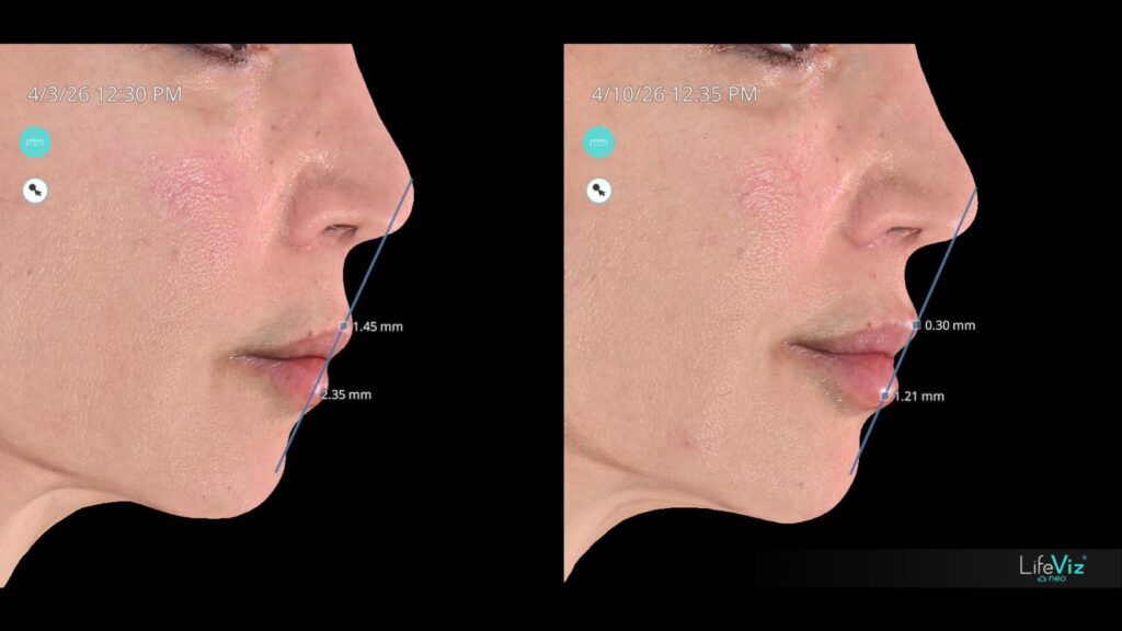 3D profile analysis before and after lip and chin enhancement dr shiva
