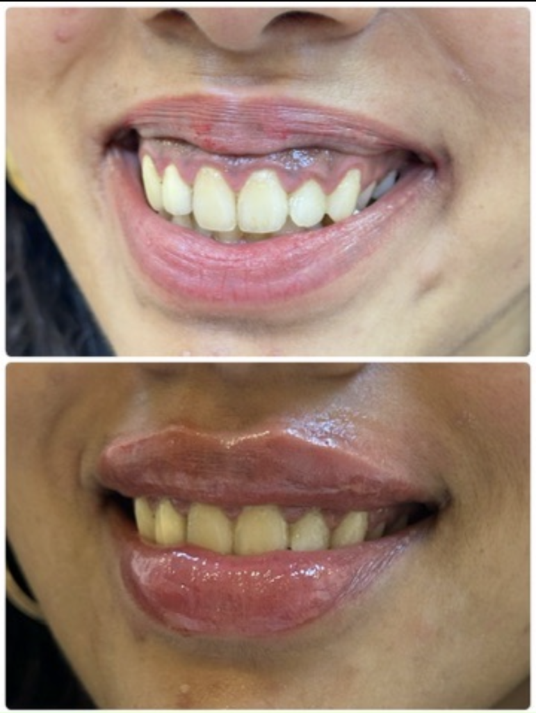 guumy smile correction dr shiva