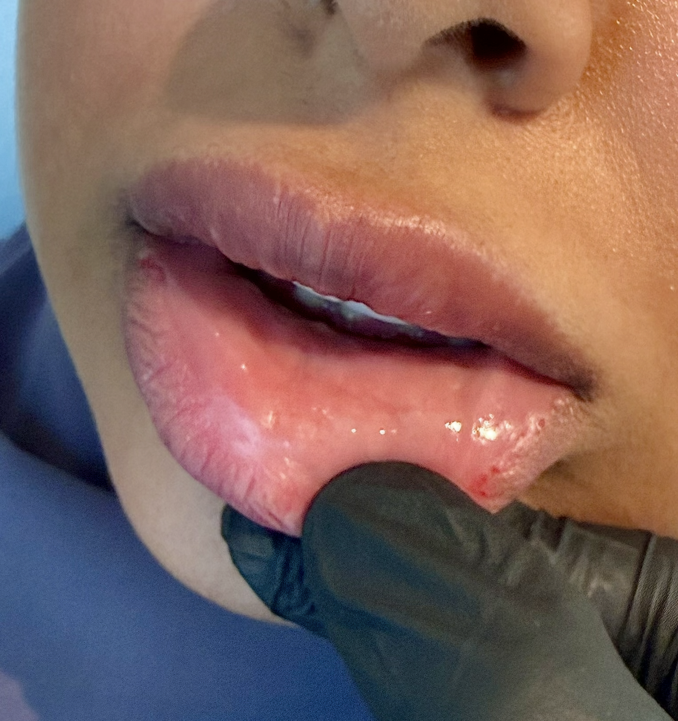 Before and after hyaluronidase dissolving lip filler bumps and accumulated hyaluronic acid along the wet-dry border of the lower lip.