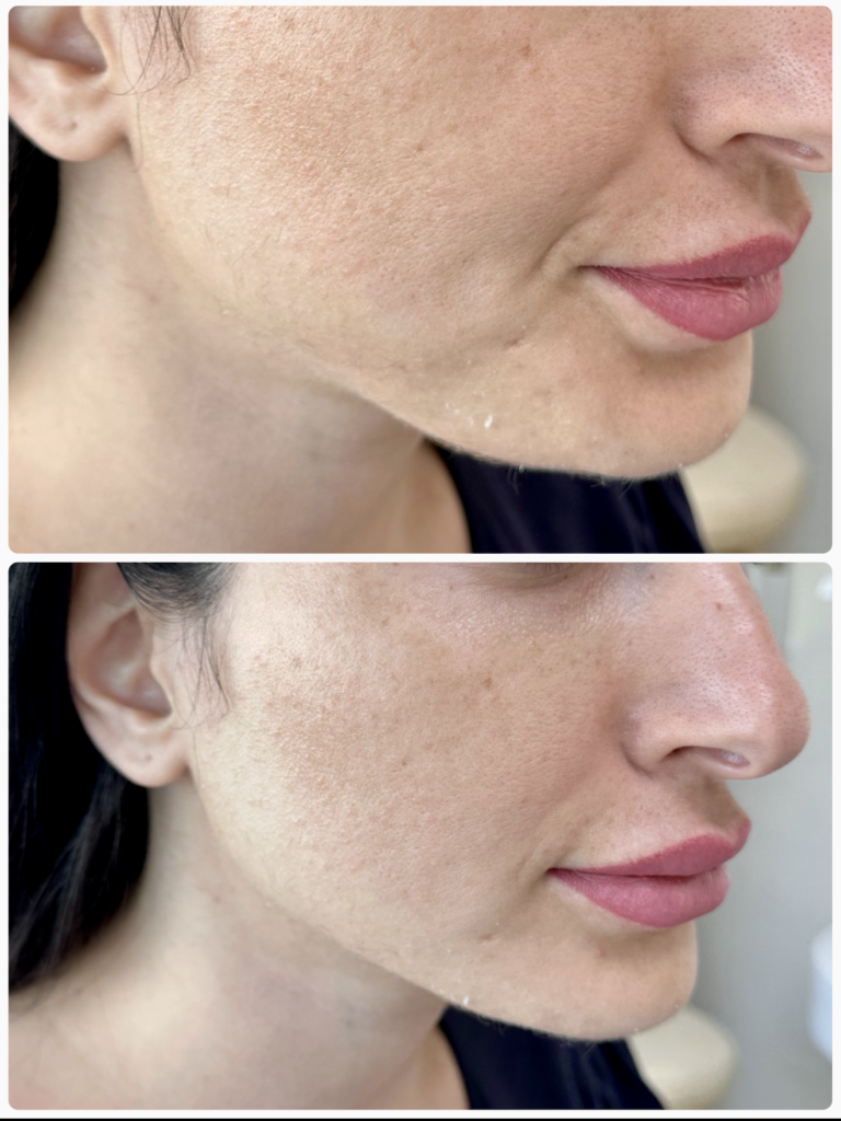 Jawline and jowl thread lift result, before and after