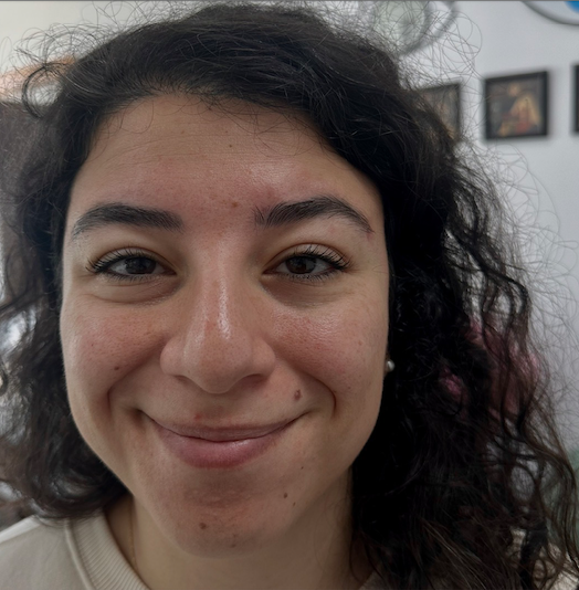 Lateral eyebrow position before and after thread lifting