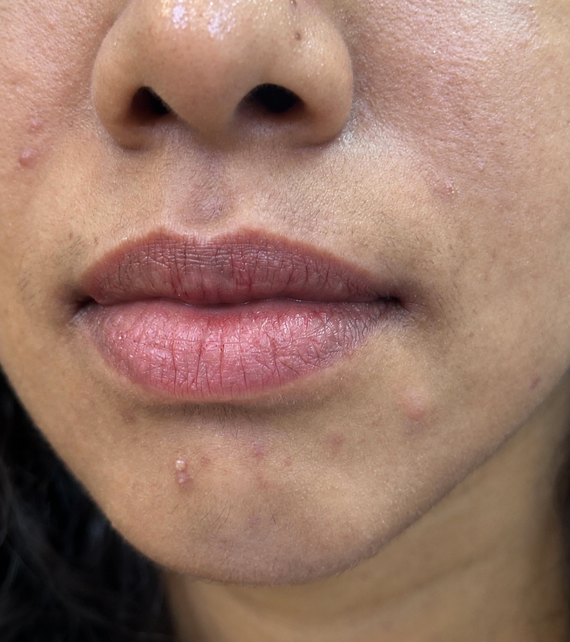 lip and chin before 1