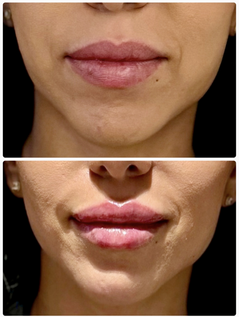 lip filler dr shiva dubai