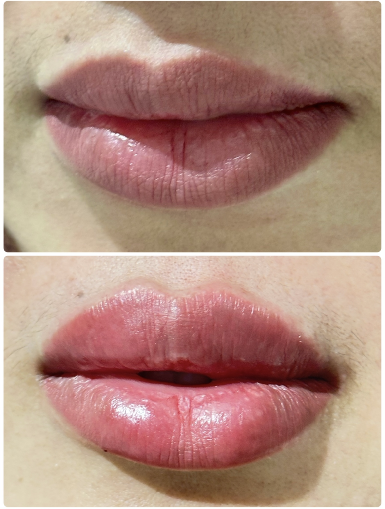 lip filler dr shiva dubai