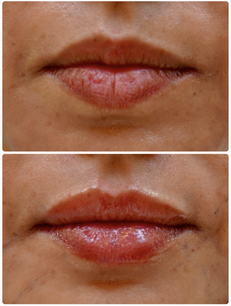 lip filler dr shiva dubai