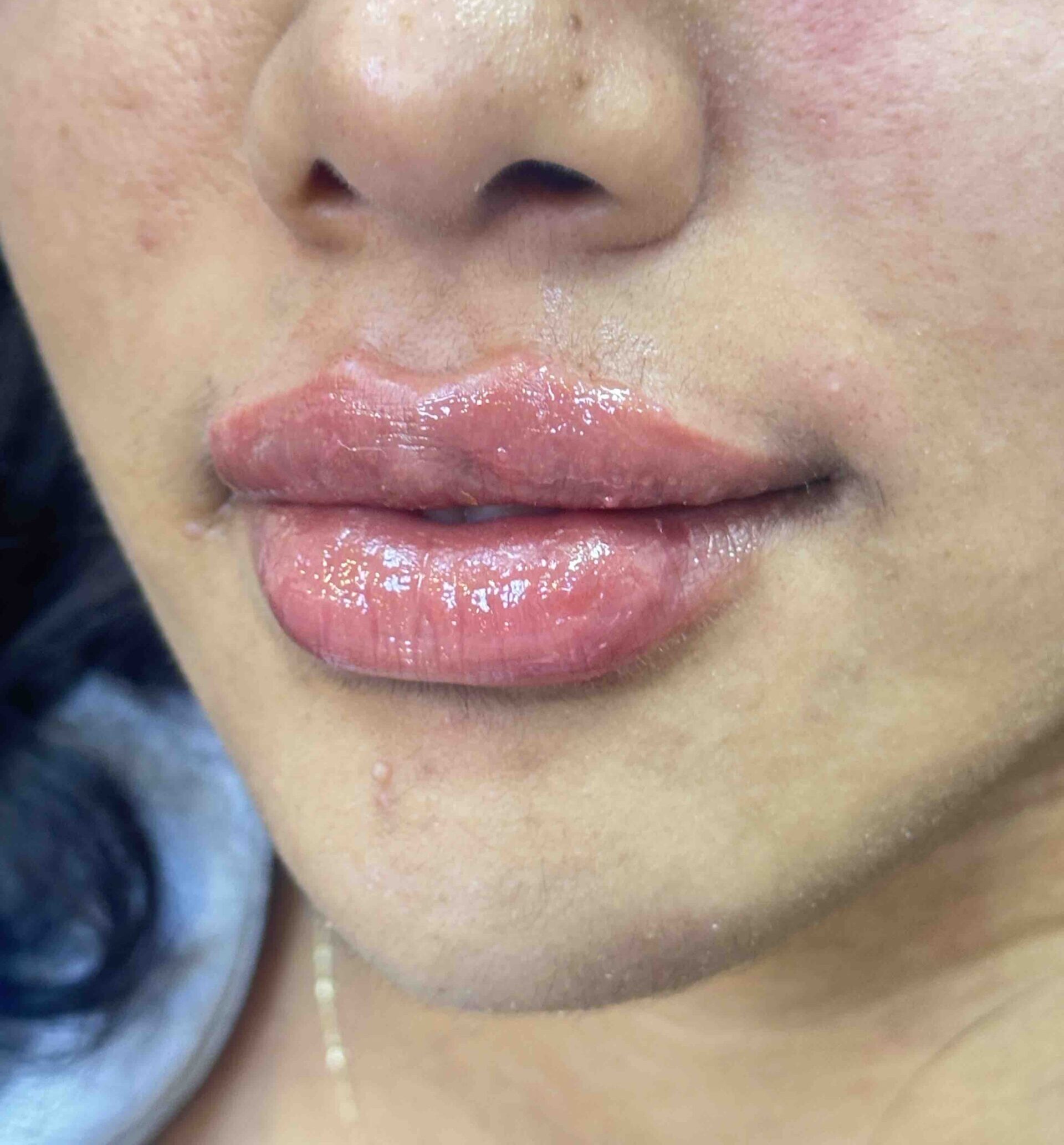 lips chin after 1