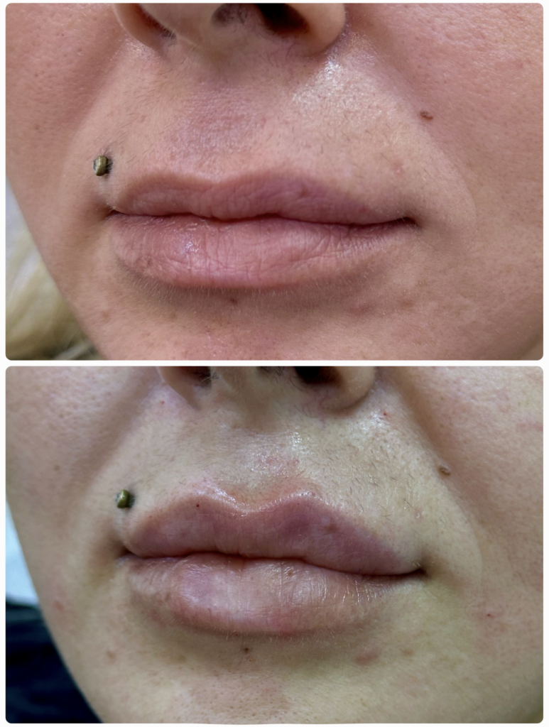 lip filler dr shiva dubai