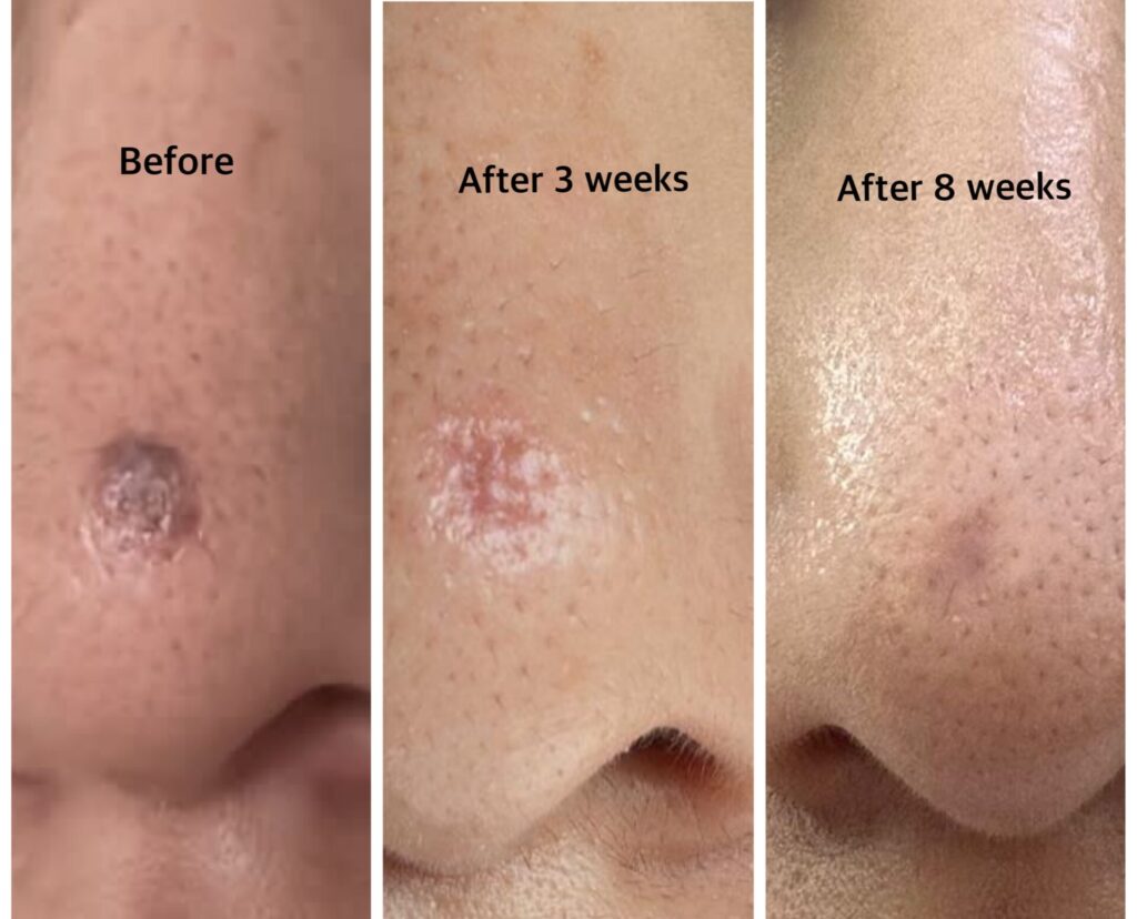 mole removal dr shiva