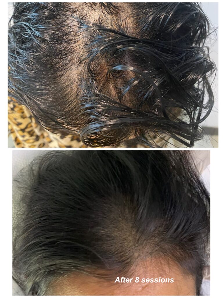 hair before after dr shiva faramarzi