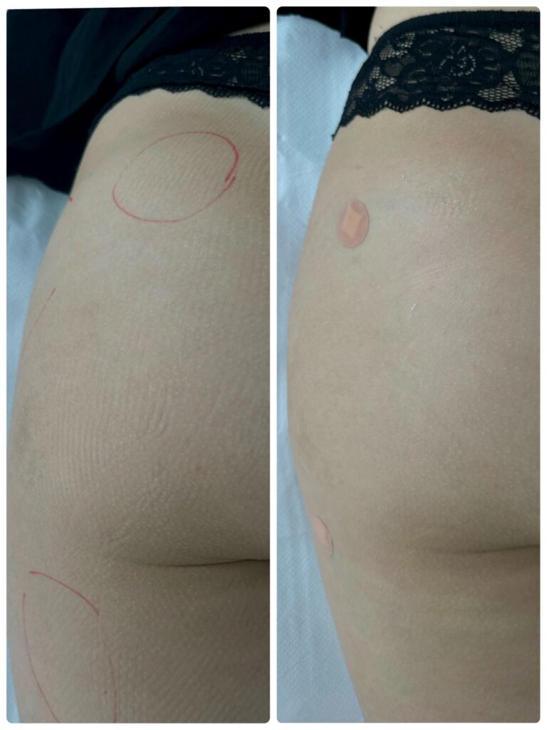 Body Filler in Dubai | Hip Dips, Buttocks & Hands | Dr Shiva Faramarzi
