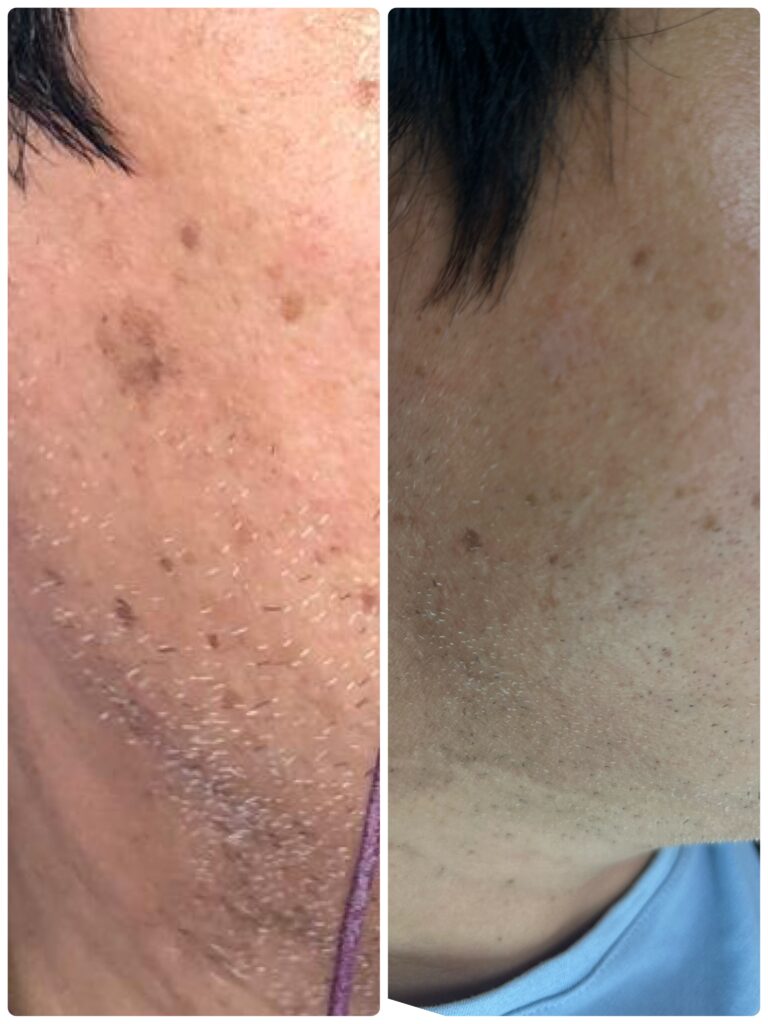 Dermoscopic examination of a mole before laser removal, Dubai clinic Er:YAG laser ablation of a benign raised mole under local anaesthetic