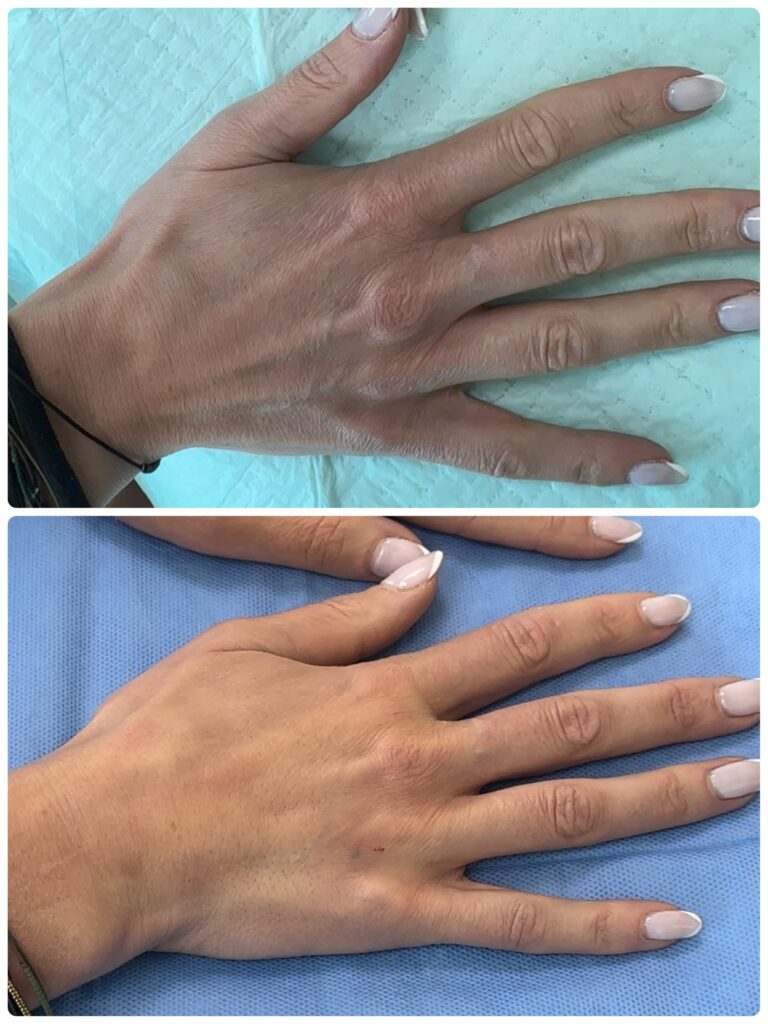 dr shiva hand filler