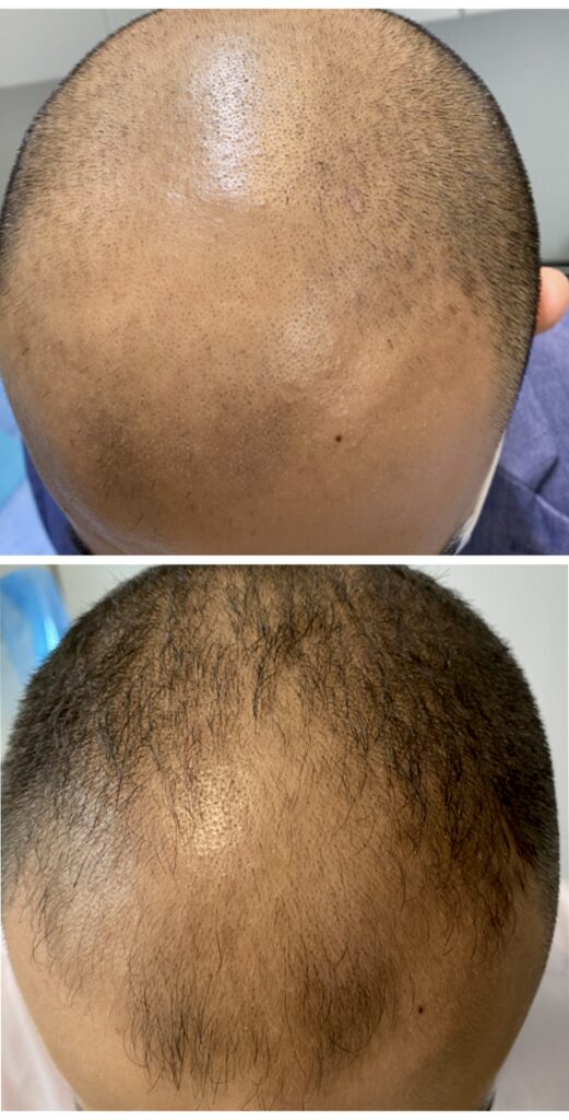 hair before after dr shiva faramarzi