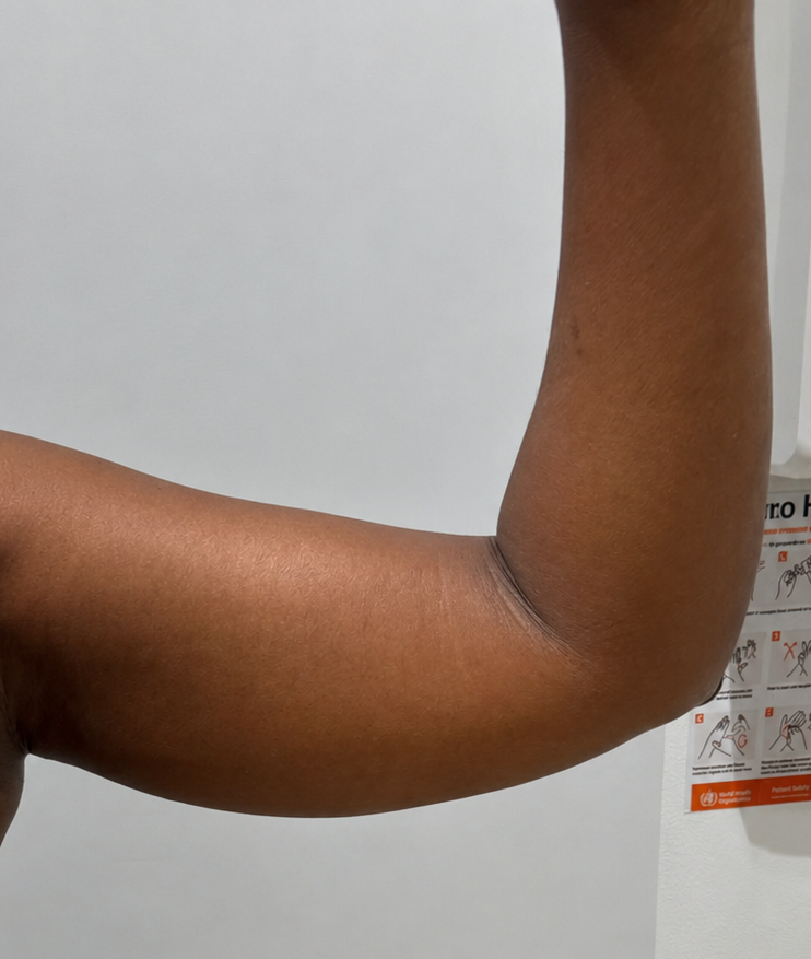 arm slimming dr shiva before