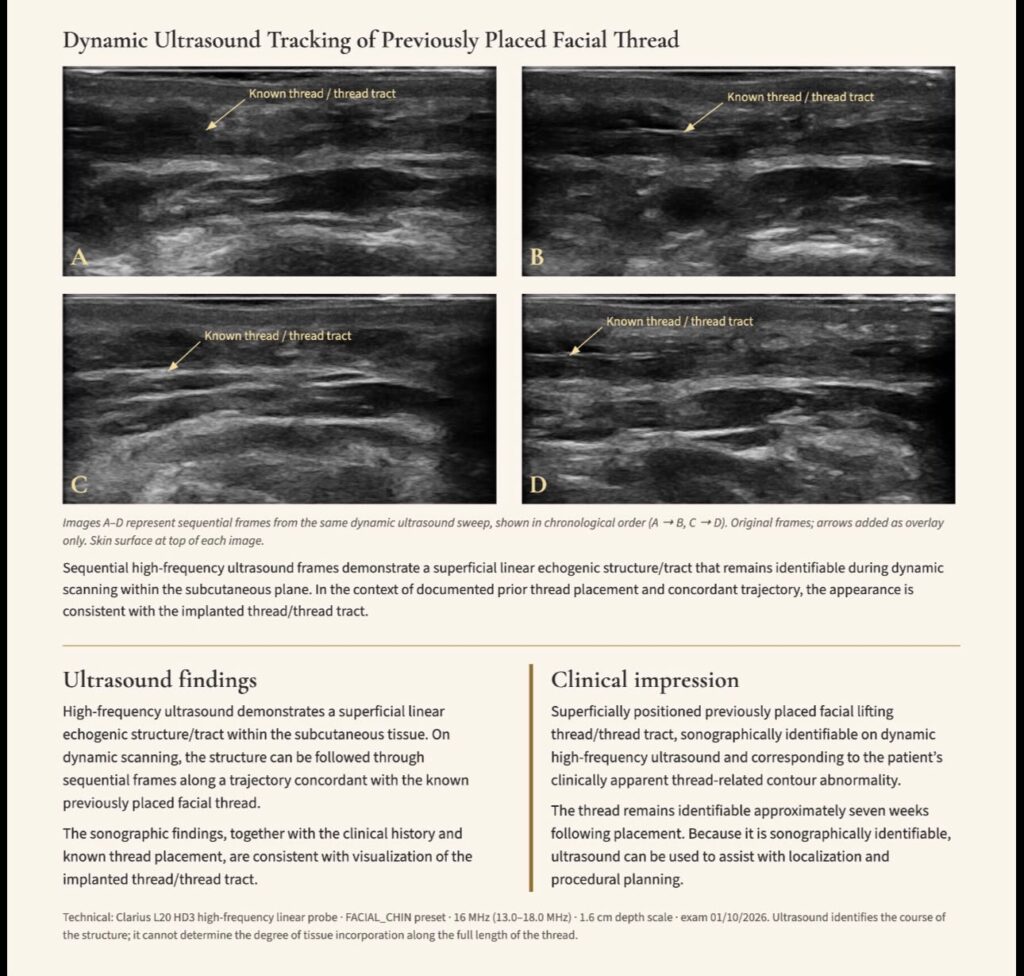 DOUBLE NEEDLE ULTRASOUND
