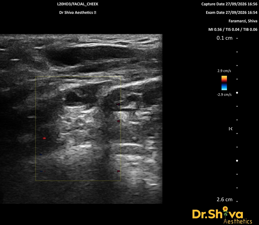Figure 3. Cheek, colour Doppler, adjacent plane. A further deposit in the same region, confirming that the product was present as separate collections across more than one plane.