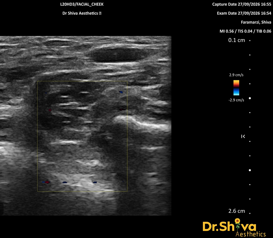 Figure 1. Cheek, B-mode. Two well-defined, almost anechoic (black) oval deposits within the soft tissue — the characteristic sonographic appearance of hyaluronic acid. The product is distributed as discrete collections rather than as a fine, even layer.