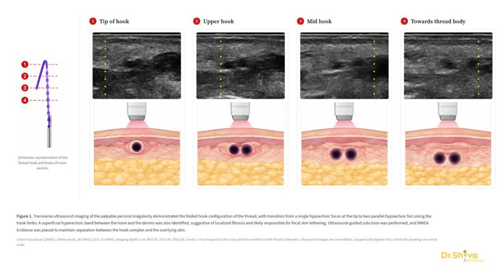 thread lift complications